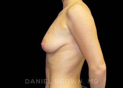 Breast Augmentation Before & After Patient #9161