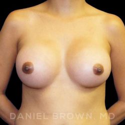 Breast Augmentation Before & After Patient #9168