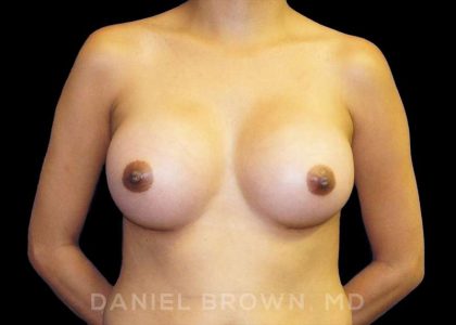 Breast Augmentation Before & After Patient #9168