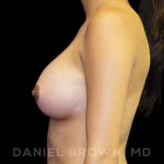 Breast Augmentation Before & After Patient #9168