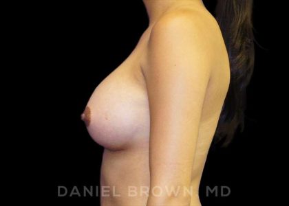 Breast Augmentation Before & After Patient #9168