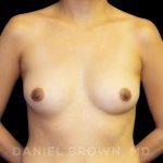 Breast Augmentation Before & After Patient #9168