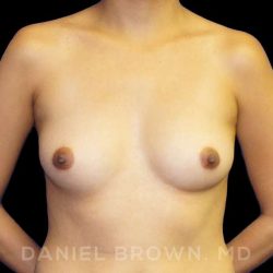 Breast Augmentation Before & After Patient #9168