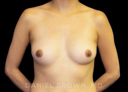 Breast Augmentation Before & After Patient #9168