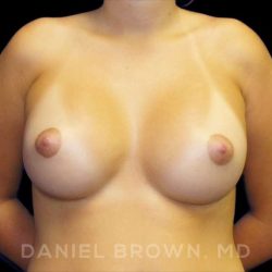 Breast Augmentation Before & After Patient #9175
