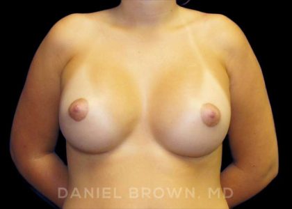 Breast Augmentation Before & After Patient #9175