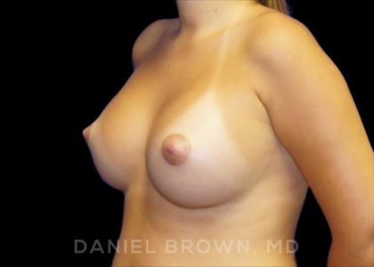Breast Augmentation Before & After Patient #9175