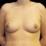 Breast Augmentation Before & After Patient #9175