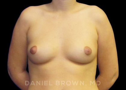 Breast Augmentation Before & After Patient #9175