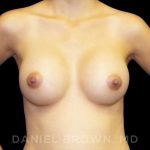 Breast Augmentation Before & After Patient #9182