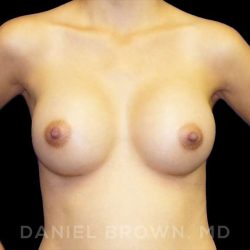Breast Augmentation Before & After Patient #9182