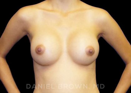 Breast Augmentation Before & After Patient #9182