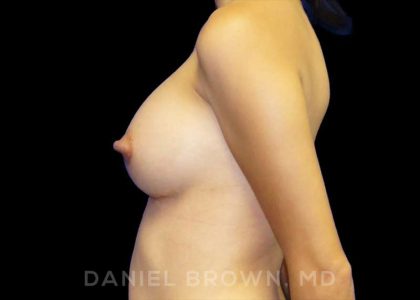 Breast Augmentation Before & After Patient #9182