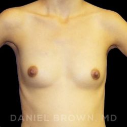 Breast Augmentation Before & After Patient #9182