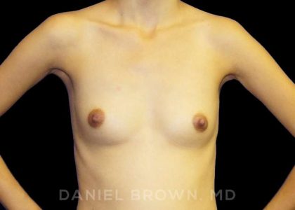 Breast Augmentation Before & After Patient #9182