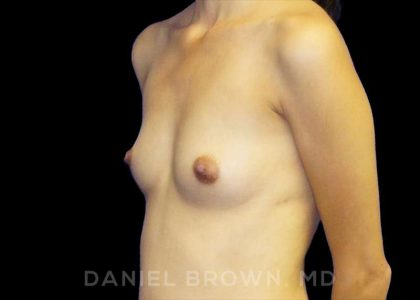 Breast Augmentation Before & After Patient #9182