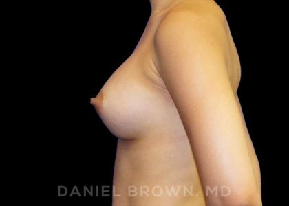 Breast Augmentation Before & After Patient #9189