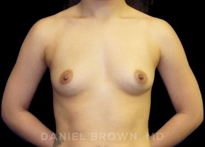 Breast Augmentation Before & After Patient #9189