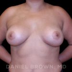 Breast Augmentation Before & After Patient #9196