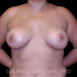 Breast Augmentation Before & After Patient #9196