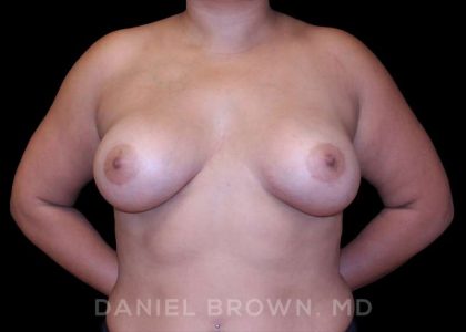 Breast Augmentation Before & After Patient #9196