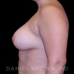 Breast Augmentation Before & After Patient #9196