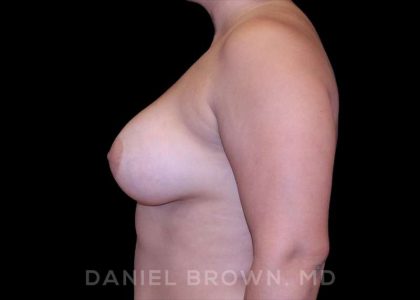 Breast Augmentation Before & After Patient #9196