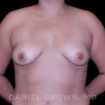 Breast Augmentation Before & After Patient #9196