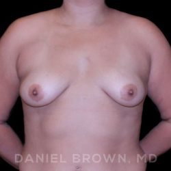 Breast Augmentation Before & After Patient #9196