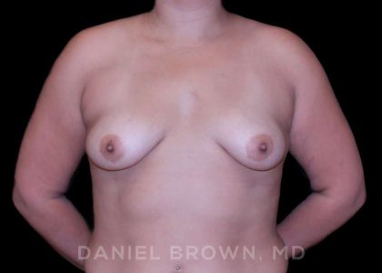 Breast Augmentation Before & After Patient #9196