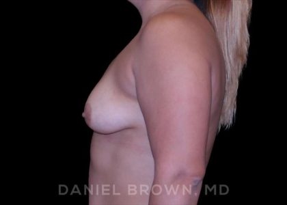 Breast Augmentation Before & After Patient #9196