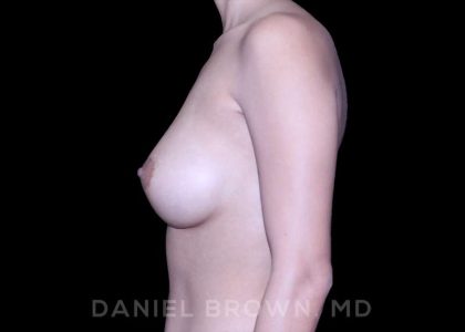 Breast Augmentation Before & After Patient #9218