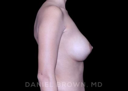 Breast Augmentation Before & After Patient #9218