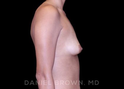 Breast Augmentation Before & After Patient #9218