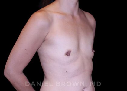 Breast Augmentation Before & After Patient #9229