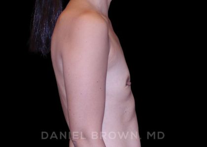 Breast Augmentation Before & After Patient #9229