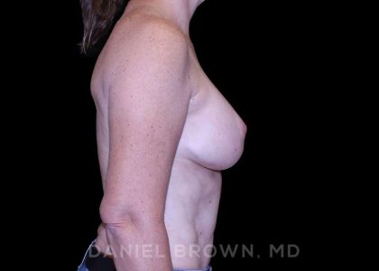 Bellesoma Breast Lift Before & After Patient #8419