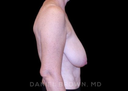 Bellesoma Breast Lift Before & After Patient #8419