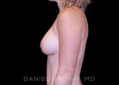 Breast Augmentation Before & After Patient #9240