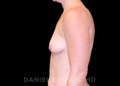 Breast Augmentation Before & After Patient #9240