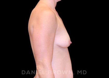 Breast Augmentation Before & After Patient #9240