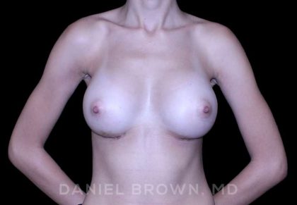 Breast Augmentation Before & After Patient #9251