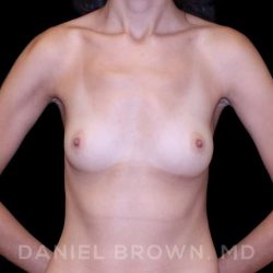 Breast Augmentation Before & After Patient #9251
