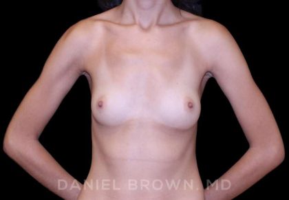 Breast Augmentation Before & After Patient #9251