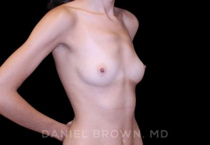 Breast Augmentation Before & After Patient #9251