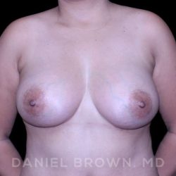 Breast Augmentation Before & After Patient #9262