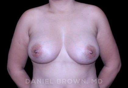 Breast Augmentation Before & After Patient #9262