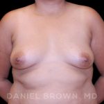 Breast Augmentation Before & After Patient #9262