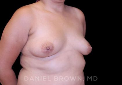 Breast Augmentation Before & After Patient #9262