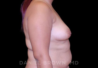 Breast Augmentation Before & After Patient #9262